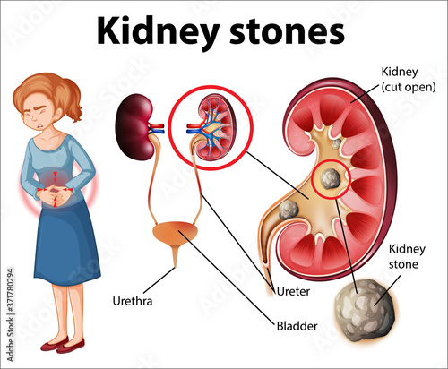 Informative illustration of kidney stones