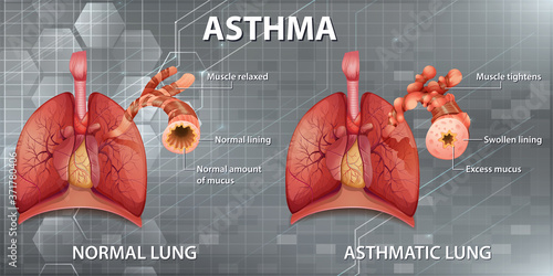Human anatomy Asthma diagram
