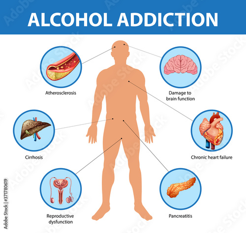 Alcohol addiction or alcoholism information infographic