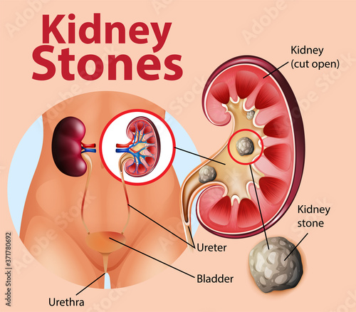 Informative illustration of kidney stones