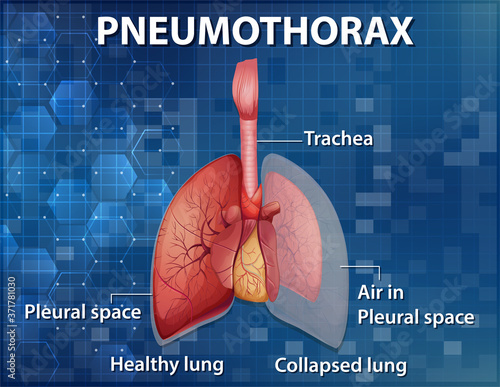 Informative illustration of Pneumothorax
