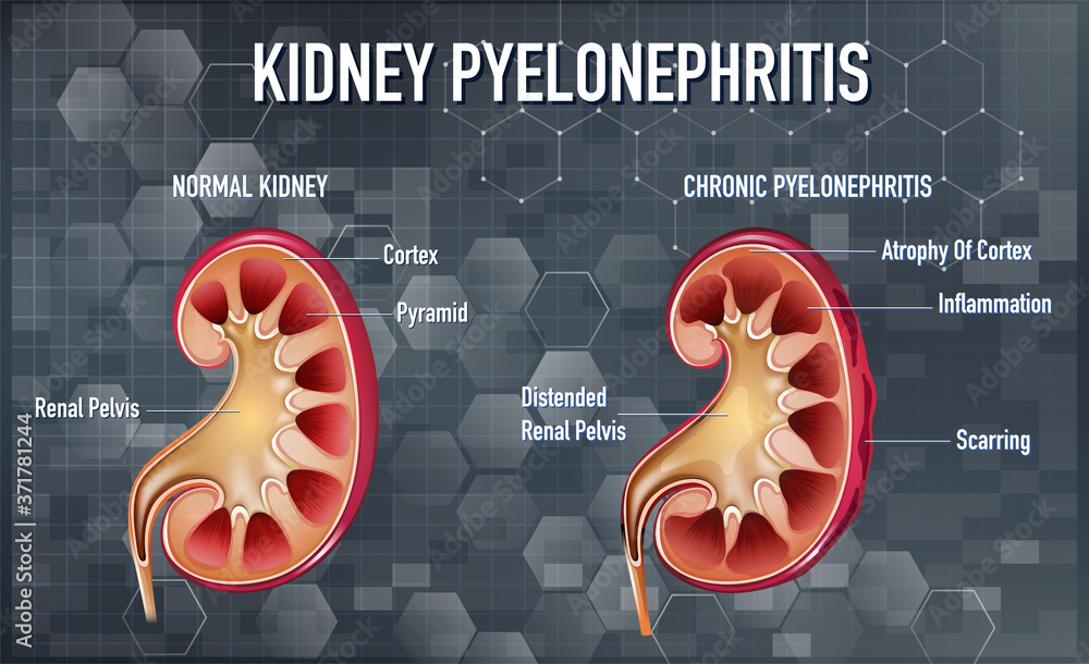 Informative illustration of Pyelonephritis Stock Vector | Adobe Stock