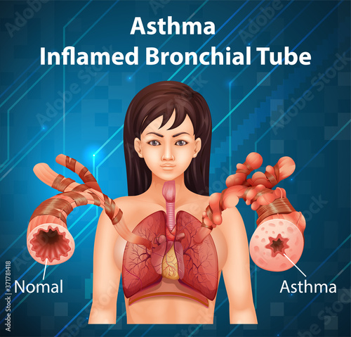 Human anatomy Asthma Inflamed Bronchial Tube diagram