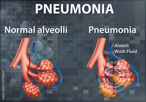 Comparison of healthy alveoli and Pneumonia
