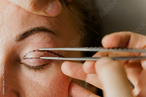 Blepharoplasty markup close-up on the face before the plastic surgery operation for modifying the eye region of the face in medical clinic. 2 doctors do plastic cosmetic operation