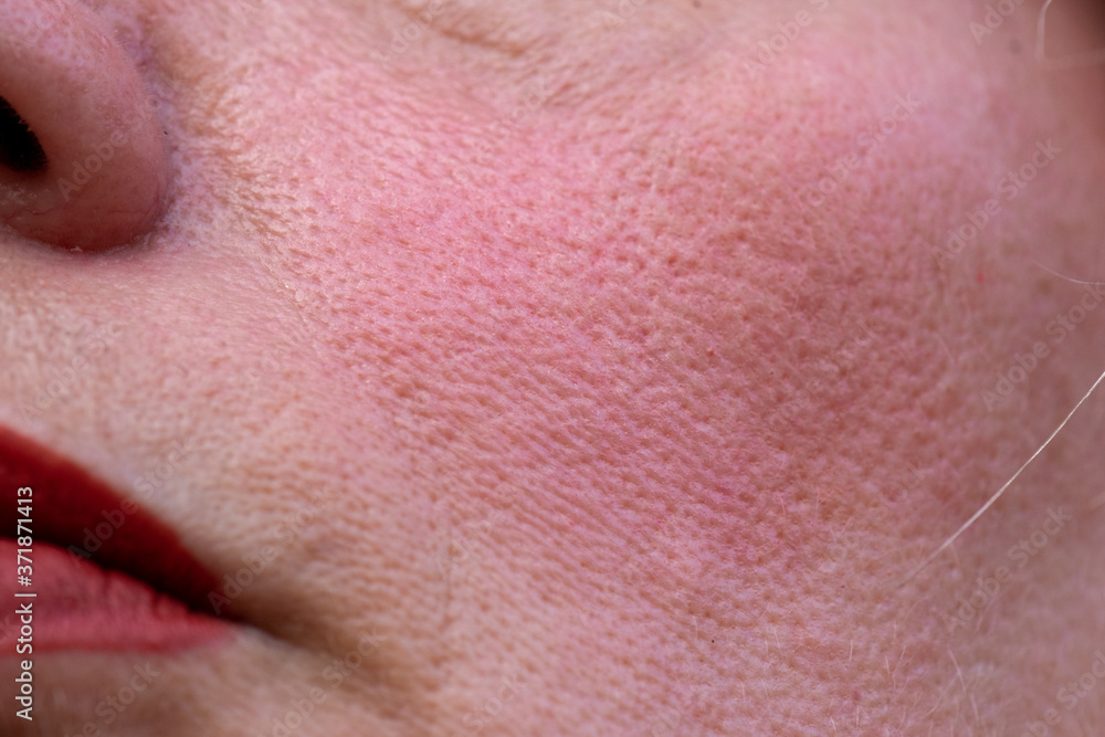 Fototapeta premium close up of ageing skin with pitted marks from acne scars 