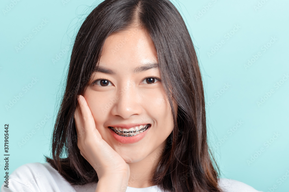 Dental braces of young asian woman wearing braces with white teeth concept. Dental braces of young asian woman wearing braces with white teeth concept.