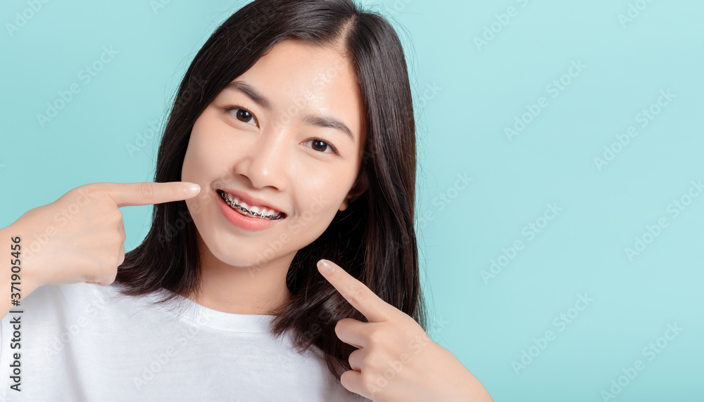 Dental braces of young asian woman wearing braces with white teeth concept. Dental braces of young asian woman wearing braces with white teeth concept.
