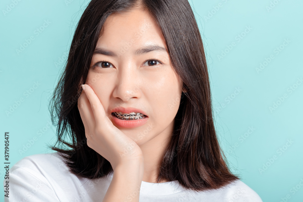 Dental braces of young asian woman wearing braces with white teeth concept. Dental braces of young asian woman wearing braces with white teeth concept.