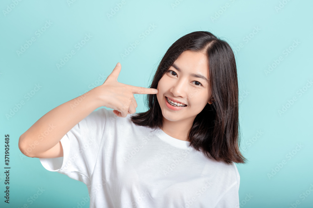 Dental braces of young asian woman wearing braces with white teeth concept. Dental braces of young asian woman wearing braces with white teeth concept.