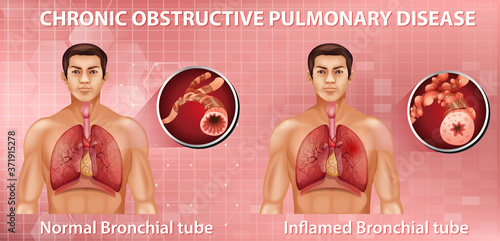 Chronic obstructive pulmonary disease