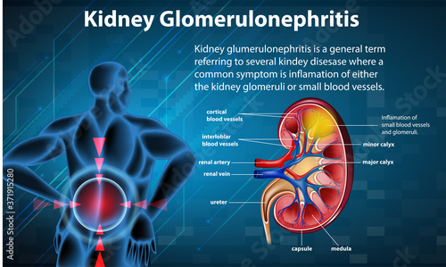 Medical infographic of kidney glomerulosclerosis photo