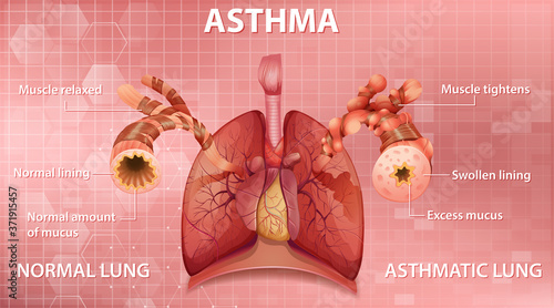 Comparison of healthy lung and Asthmatic lung