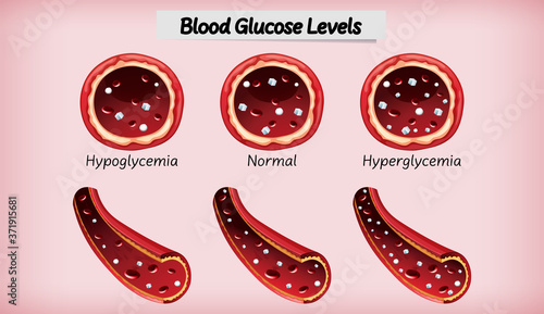 Medical blood glucose level