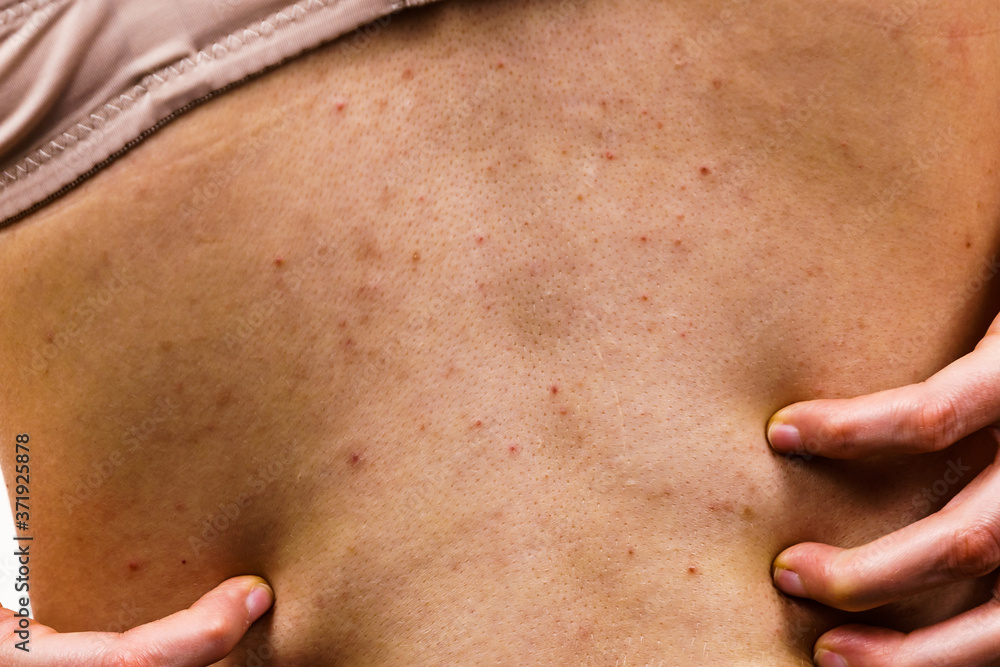 Fototapeta premium Woman with skin problem acne on back