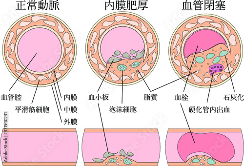 血管閉塞