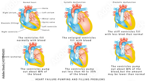 Heart failure. Heart Failure - Pumping and Filling Problems,  Systolic Dysfunction, Diastolic Dysfunction. Heart failure or congestive heart failure. Diseases of the Heart.  photo
