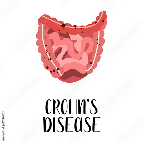 Crohn's disease. Intestines diseases. Gastroenterology. Vector flat illustration. Perfect for flyer, medical brochure, banner, landing page, website