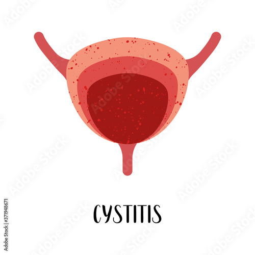 Cystitis. Bladder disease. Urology. Vector flat illustration. Perfect for flyer, medical brochure, banner, landing page, website