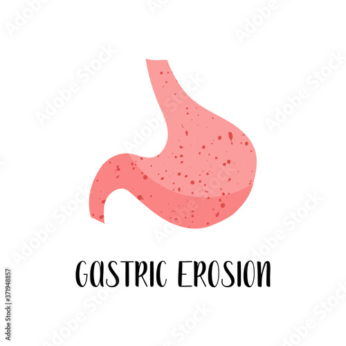Gastric erosion. Stomach disease. Gastroenterology. Vector flat illustration. Perfect for flyer, medical brochure, banner, landing page, website
