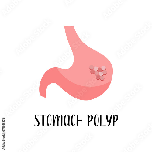 Stomach polyp, gastric disease. Gastroenterology. Vector flat illustration. Perfect for flyer, medical brochure, banner, landing page, website