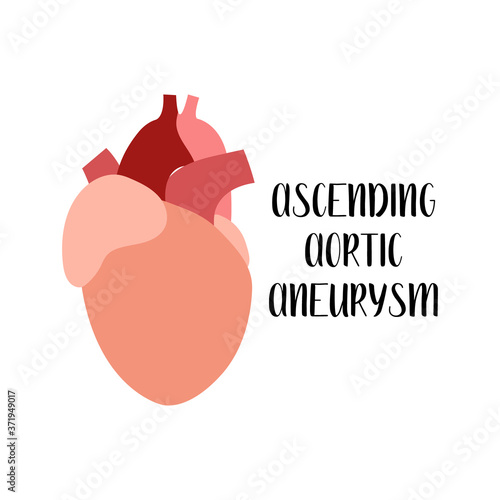 Ascending aortic aneurysm. Heart, cardiovascular diseases. Cardiology. Vector flat illustration. For flyer, medical brochure, banner, landing page, web