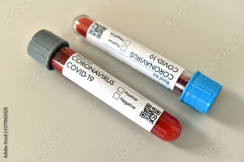 Coronavirus test. Covid 19 infected positive result blood test sample in research tube in laboratory where vaccine research is tested on Covid-19 