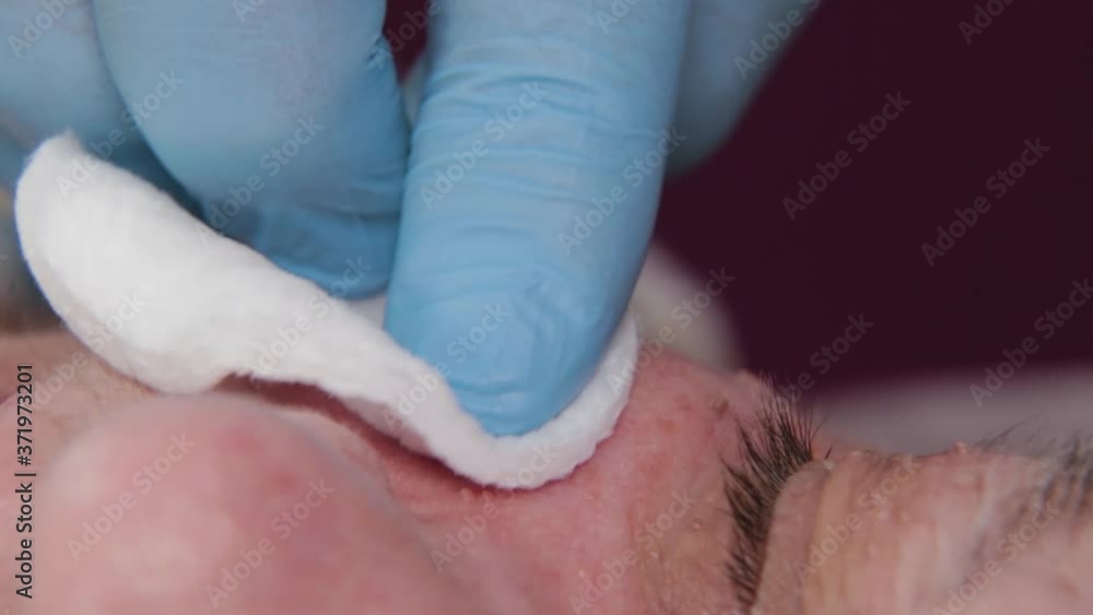 Male doctor removes papillomas of an elderly woman with an electric scalpel. Male doctor removes papillomas of an elderly woman with an electric scalpel.