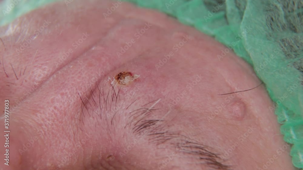 Male doctor removes papillomas of an elderly woman with an electric scalpel. Male doctor removes papillomas of an elderly woman with an electric scalpel.