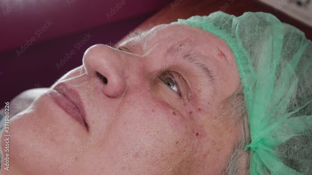 Male doctor treats papilloma removal sites in an elderly woman. Male doctor treats papilloma removal sites in an elderly woman.