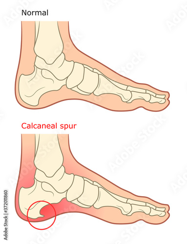 Calcaneal spur illustration. Healthy foot and diseased foot with spur.  photo