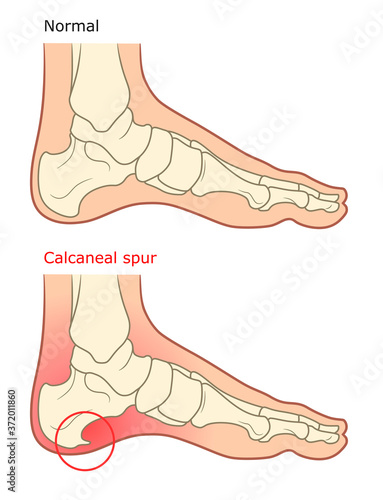 Calcaneal spur illustration. Healthy foot and diseased foot with spur. 