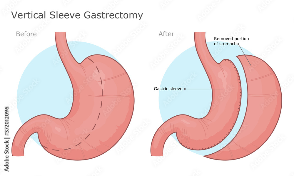 Vertical sleeve gastrectomy surgery illustration Stock Vector Adobe Stock