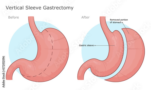 Vertical sleeve gastrectomy surgery illustration