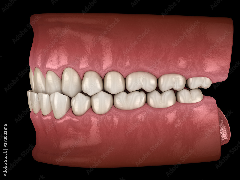 Underbite dental occlusion ( Malocclusion of teeth ). Medically accurate tooth 3D illustration