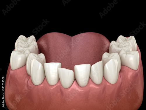 Photos Abnormal teeth position, orthodontic concept