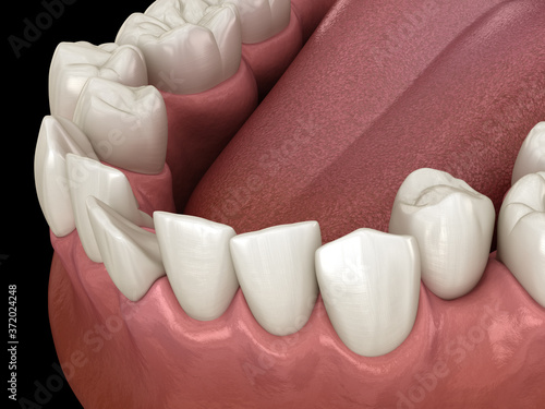 Принти на полотні Abnormal teeth position, orthodontic concept