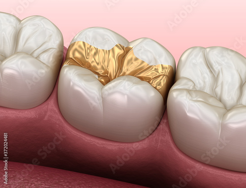 Golden Inlay crown fixation over tooth. Medically accurate 3D illustration of human teeth treatment