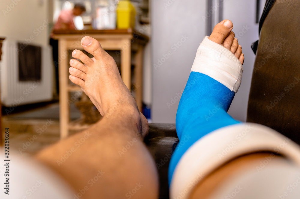 Male resting cast on chair elevated from foot surgery Male resting cast on chair elevated from foot surgery