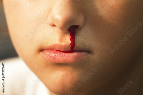 Epistaxis. Nosebleed , a young woman suffering from nose bleeding. Healthcare and medical concept . Selective focus photo