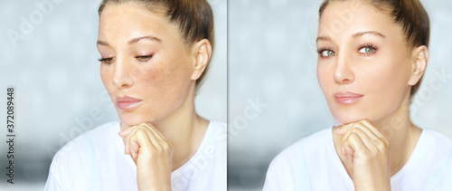 Bilde på lerret Dark spots, freckles,hyperpigmentation(melasma or chloasma),concept- skin lighte
