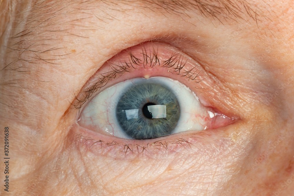 Macro shot of an eye with a stye filled with pus on the eyelid Macro shot of an eye with a stye filled with pus on the eyelid