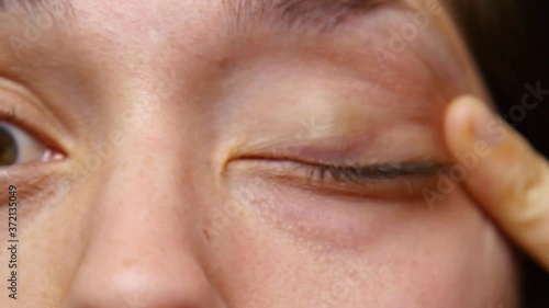 Person rubs eye with eye infection. photo