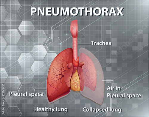 Informative illustration of Pneumothorax