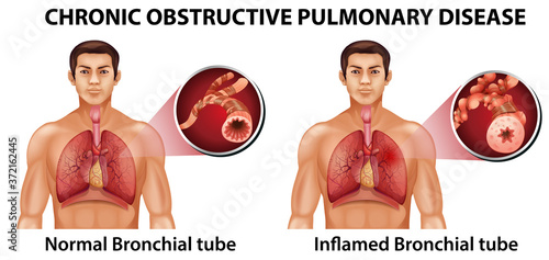 Chronic obstructive pulmonary disease