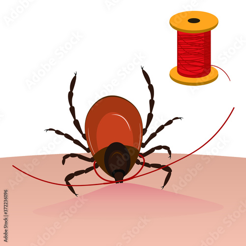 A tick is taken out of the skin with a thread. Tick bite. Vector illustration