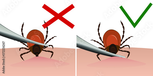 A tick is removed from the skin with tweezers. Tick bite. Vector illustration