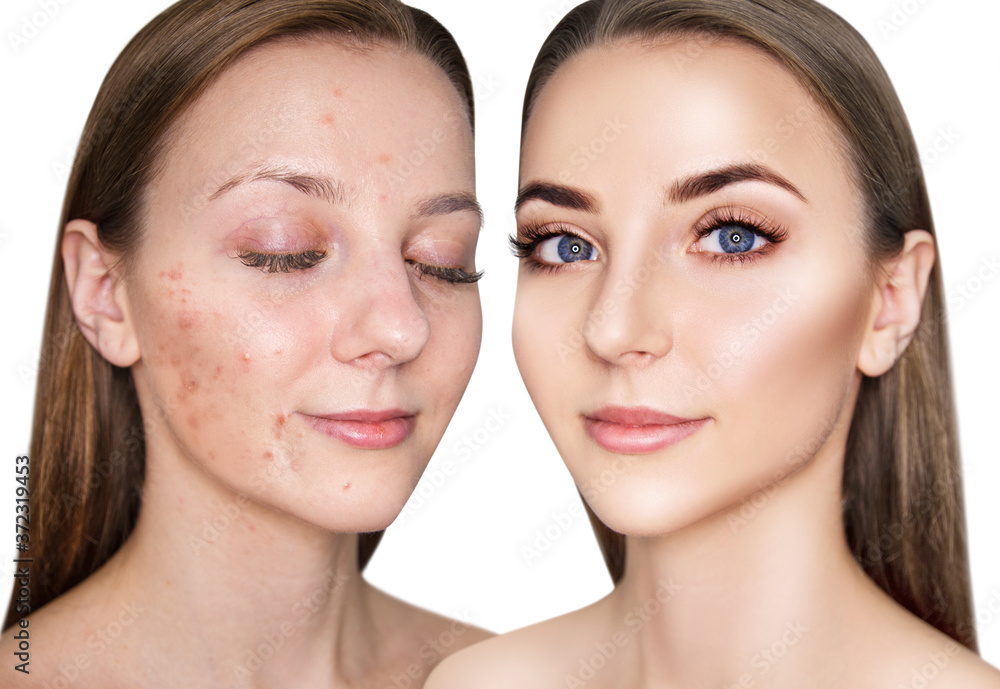 Face of beautiful woman before and after acne treatment. Face of beautiful woman before and after acne treatment.