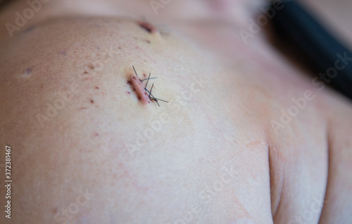 close up of a patient 3 stitches from a surgery from a shoulder procedure with 