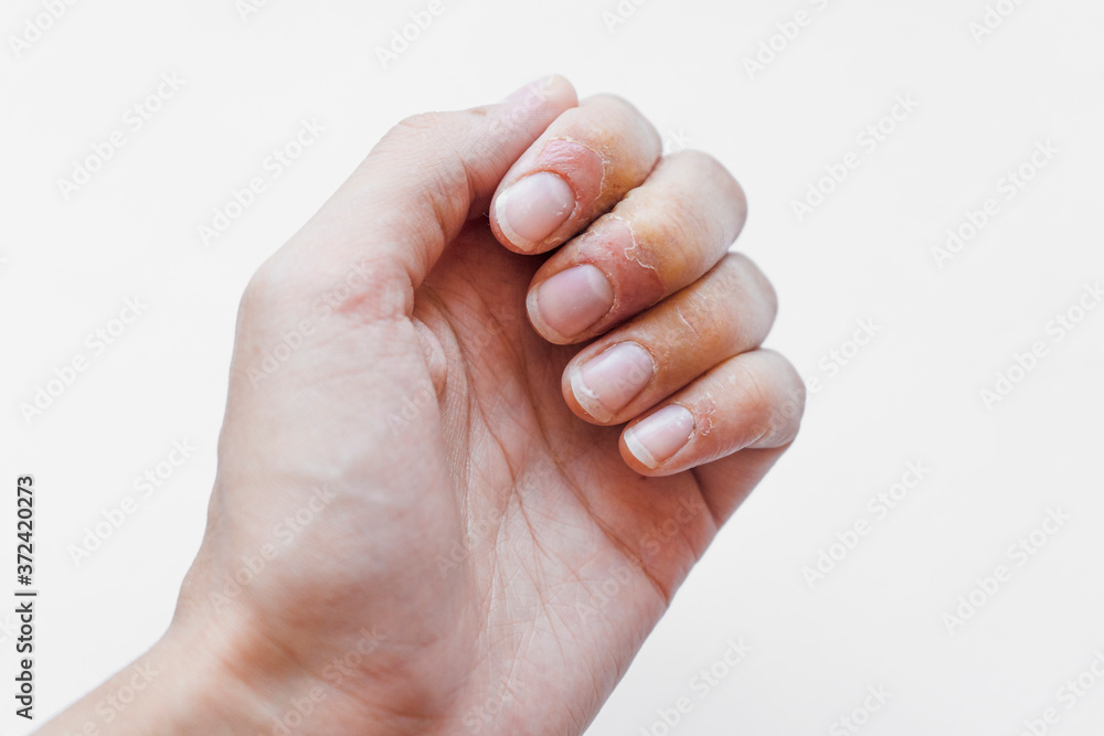 Psoriatic nail disease and psoriatic skin plaques on hands of a patient with psoriasis. Psoriasis is an autoimmune disease that affects the skin cause skin inflammation red and scaly, with signs Psoriatic nail disease and psoriatic skin plaques on hands of a patient with psoriasis. Psoriasis is an autoimmune disease that affects the skin cause skin inflammation red and scaly, with signs